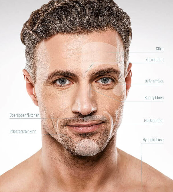 Anwendung Botox, Praxis Dermatologie München, Steinkraus Skin